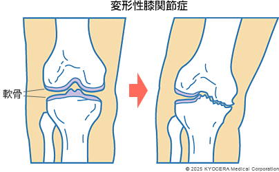 変形性膝関節症の図