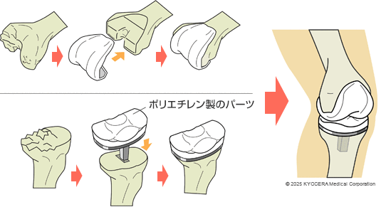 人工膝関節置換術の図