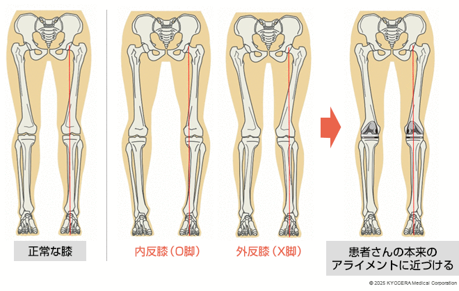 キネマティックアライメント法の図