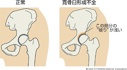 寛骨臼形成不全の図