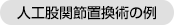 人工股関節置換術の例