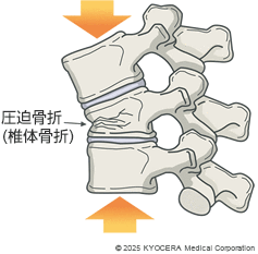 圧迫骨折(椎体骨折)の図