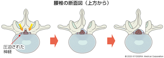 除圧術の例の図
