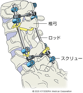固定術の例の図