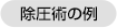 除圧術の例