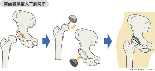 表面置換型人工股関節