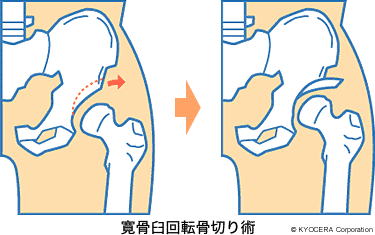 寛骨臼回転骨切り術