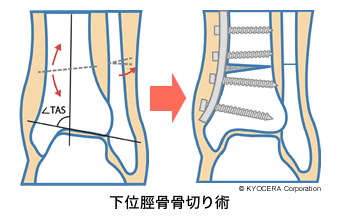 下位脛骨骨切り術