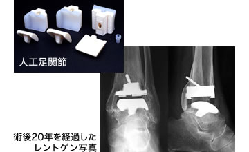 人工足関節・術後20年を経過したレントゲン写真