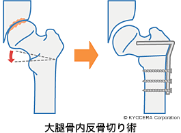 大腿骨内反骨切り術