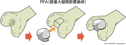 PFA（膝蓋大腿関節置換術）