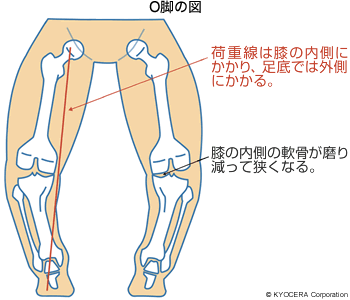 O脚の図