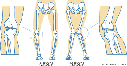 内反変形 外反変形