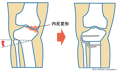 HTO（高位脛骨骨切り術）