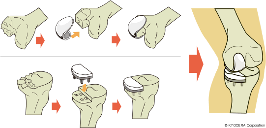 人工膝関節片側的置換術