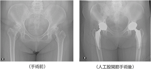 手術前 人工股関節手術後
