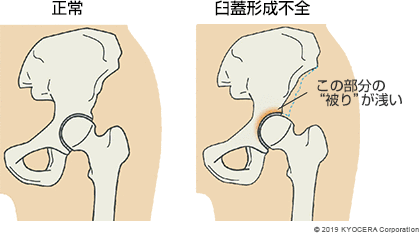 正常 臼蓋形成不全