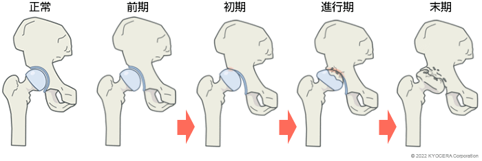 正常 前期 初期 進行期 末期