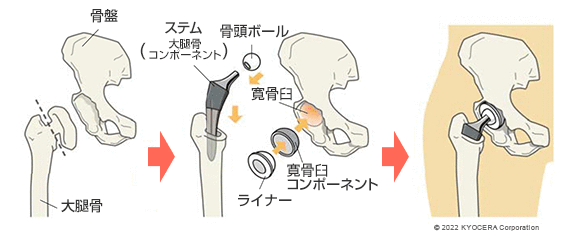 外反骨切り術 大腿骨内反骨切り術 イメージ