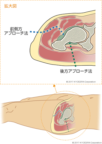 前側方アプローチ法 後方アプローチ法