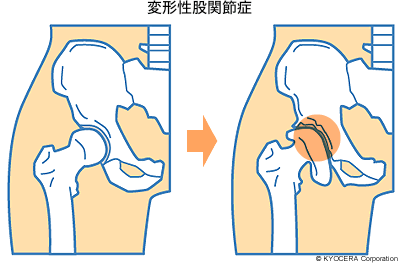 変形性股関節症