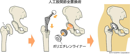 人工股関節全置換術