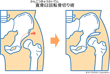 寛骨臼回転骨切り術 イラスト