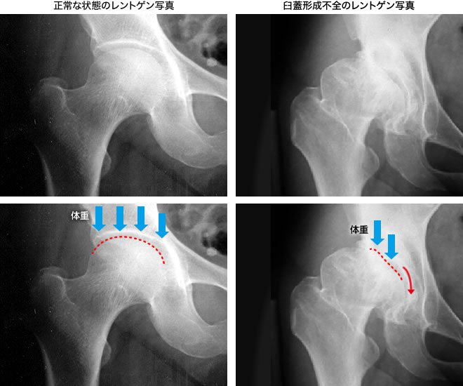 正常な状態のレントゲン写真 臼蓋形成不全のレントゲン写真