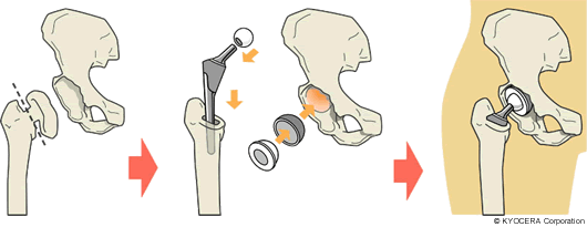 全人工股関節置換術 イラスト