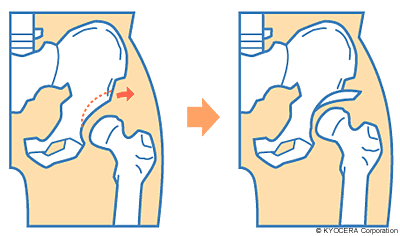 寛骨臼回転骨切り術 イラスト