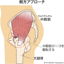 側方アプローチ