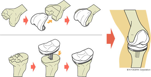 全人工膝関節置換術（TKA）