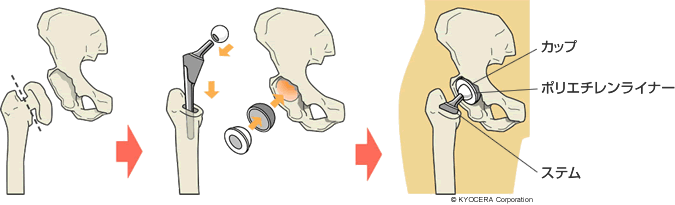 人工股関節全置換術