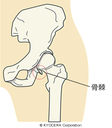 骨棘