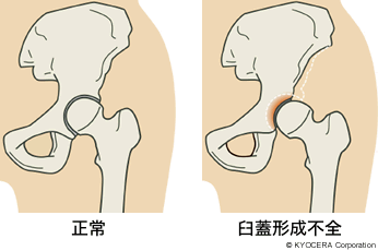 正常 臼蓋形成不全