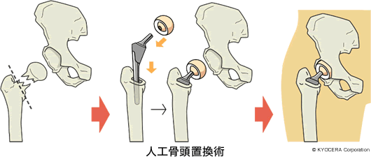 人工骨頭置換術