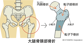 大腿骨頸部骨折