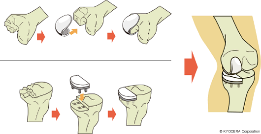 人工膝関節単顆置換術（UKA）