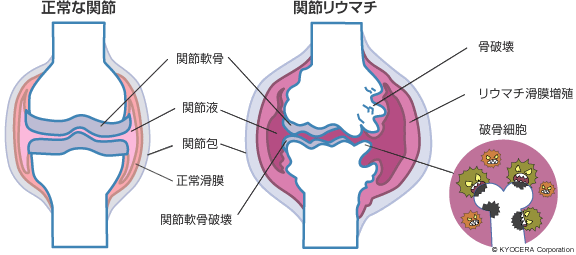 正常な関節 関節リウマチ