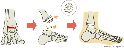 人工足関節置換術