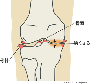 膝関節の骨棘