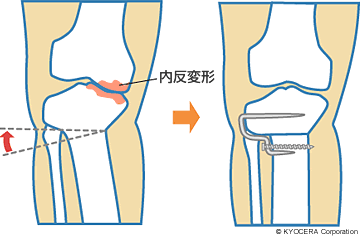 高位脛骨骨切り術