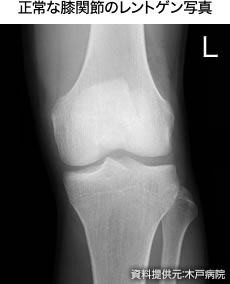 正常な膝関節のレントゲン写真