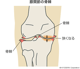 膝関節の骨棘