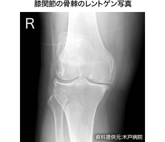 膝関節の骨棘のレントゲン写真