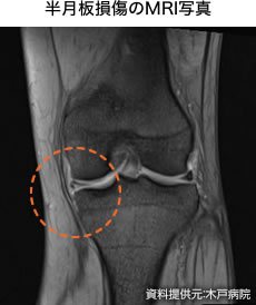 半月板損傷のMRI写真