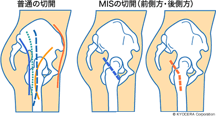 普通の切開・MISの切開（前側方・後側方）