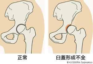 正常 臼蓋形成不全