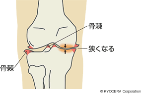膝関節の骨棘