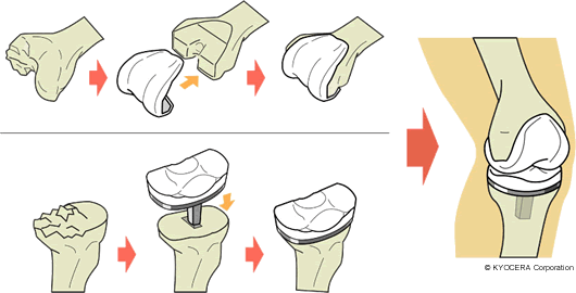 人工膝関節全置換術（TKA）